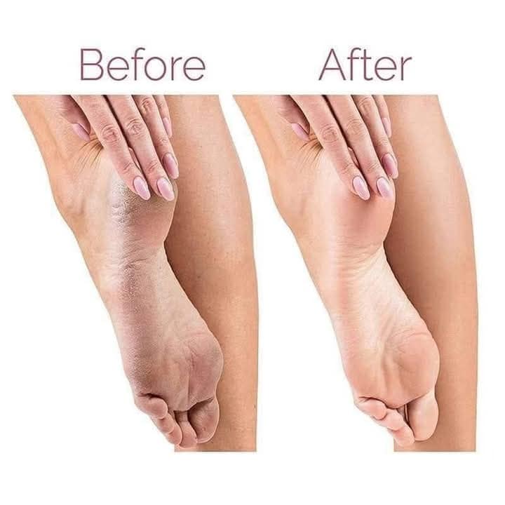 الجهاز الذكي للقدمين _ Finishing Touch Flawless™ Pedi Electronic Pedicure Tool